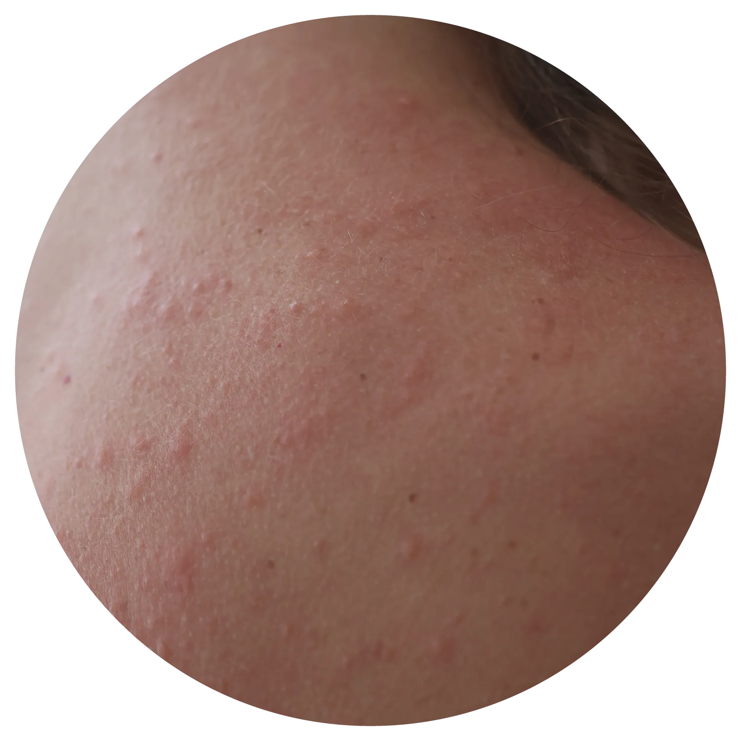 Back Acne treatment process at Toronto medical spa - The body's largest surface—reflecting what's happening inside.